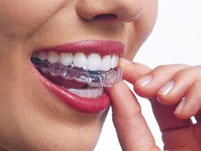 Transparente Aligner und Ernährung: Welche Lebensmittel Sie während der Behandlung vermeiden sollten