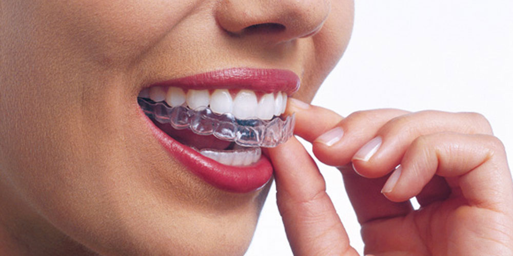 Transparente Aligner und Ernährung: Welche Lebensmittel Sie während der Behandlung vermeiden sollten