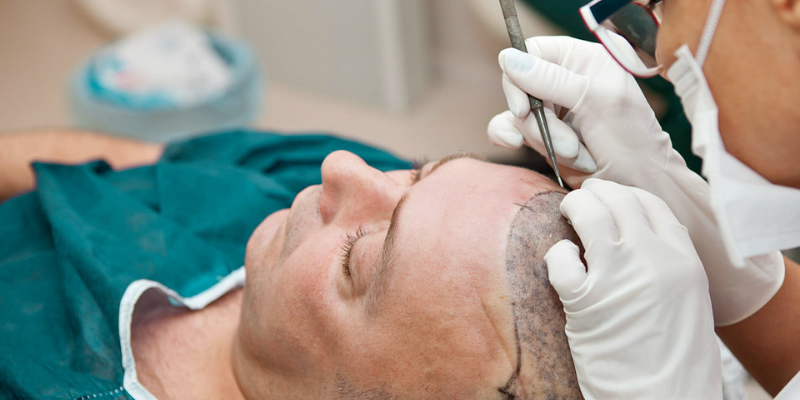 Haarausfall Nürnberg: Haarausfall bei Männern und Frauen – Unterschiede und Lösungen